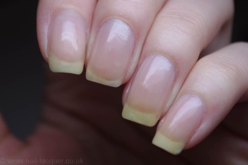 Yellow nails caused by what?

