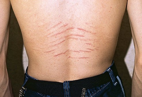 How to reduce stretch marks